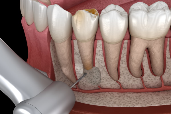Tooth Cystectomy Surgery - recovery after Periostitis . Medically accurate 3D illustration