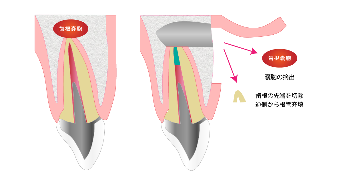 根はどうなるのでしょうか?